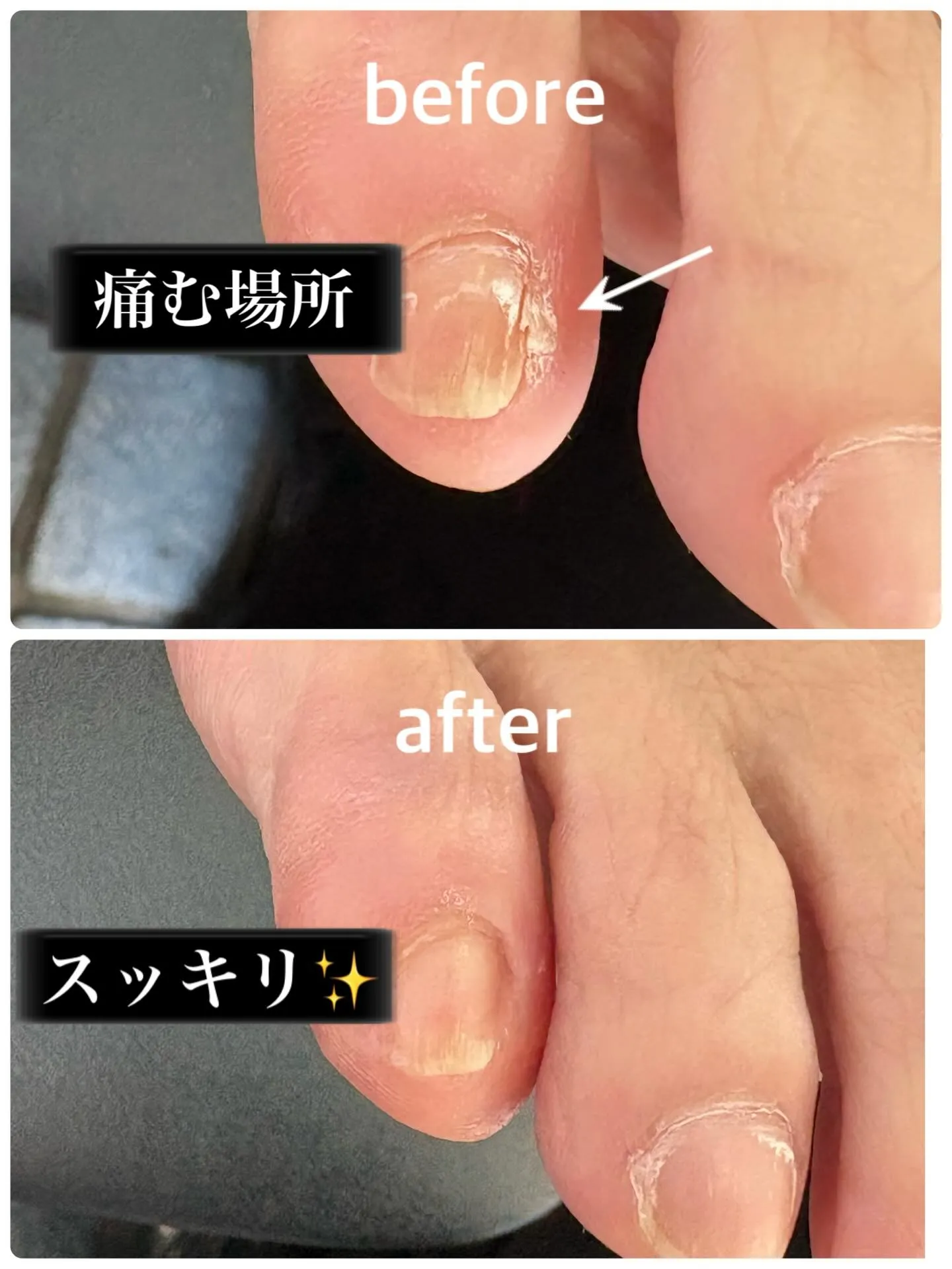 小指の内側が痛いとお悩みだったお客様。